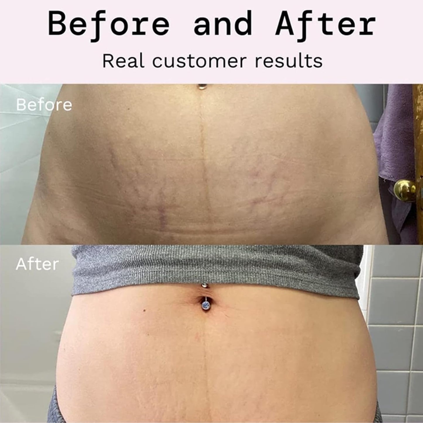 Stretch Mark Prevention Cream for Pregnancy, Stretch Mark Cream Remover, Stretch Mark Lotion for Pregnancy, Tummy Butter for Stretch Marks Pregnancy, Shea Butter Stretch Mark Removal Cream